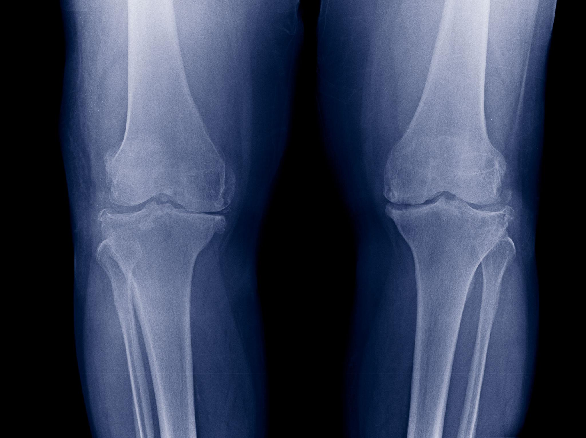 Bone Treatment