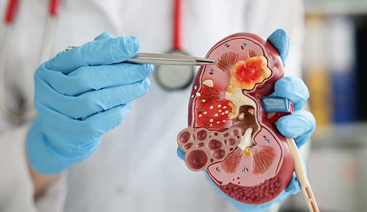 IVF